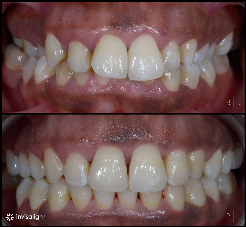 invisalign-antibes-juan-les-pins-c2