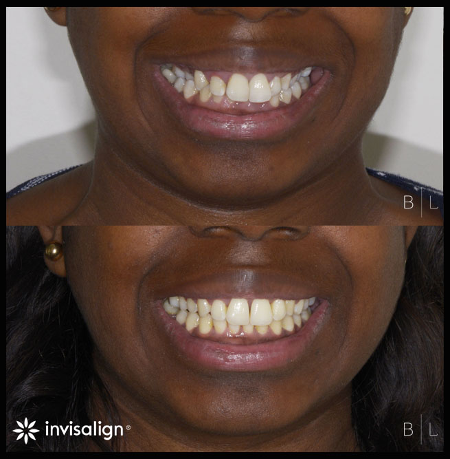 invisalign-antibes-juan-les-pins-c2