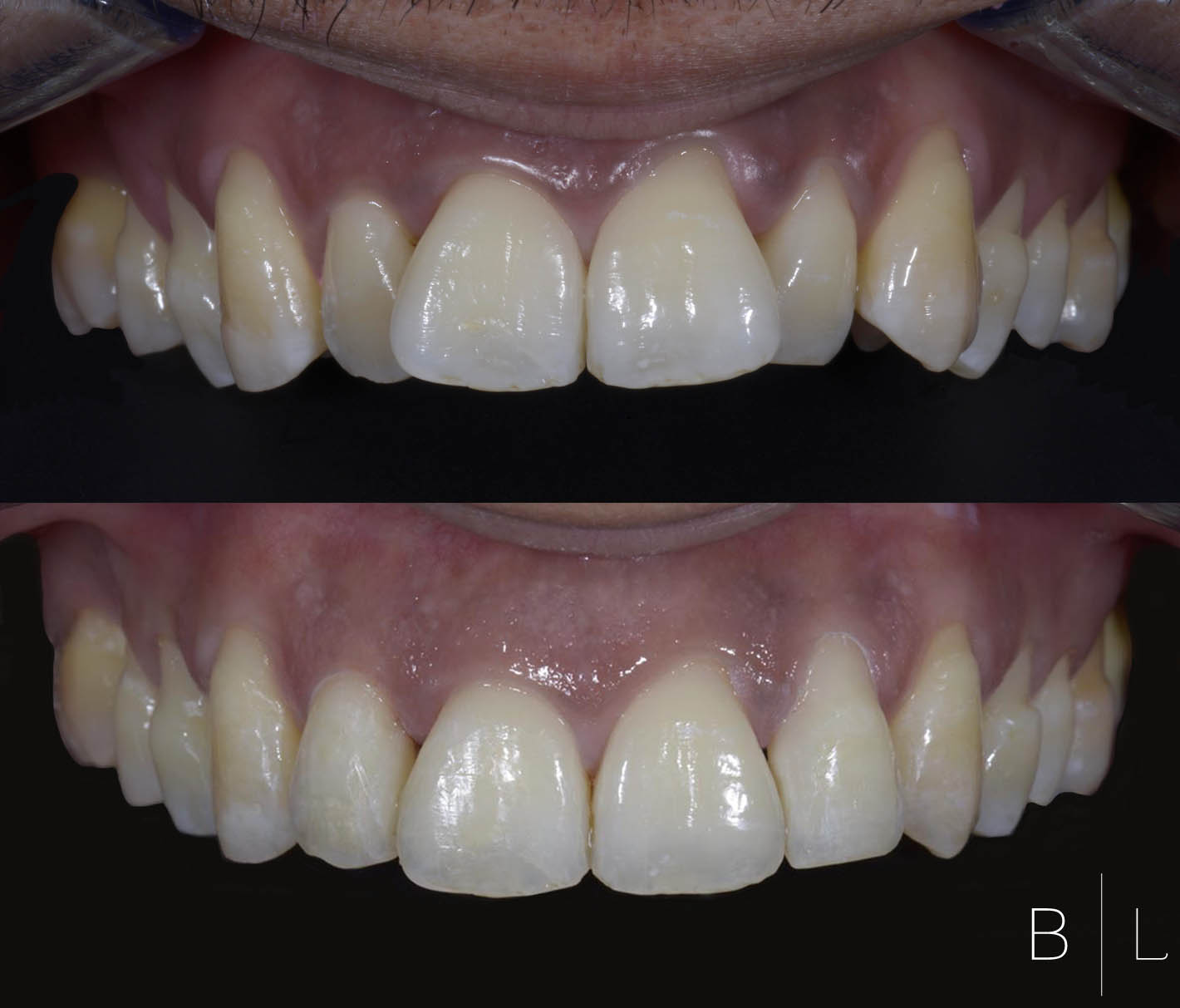 invisalign-antibes-juan-les-pins-c2