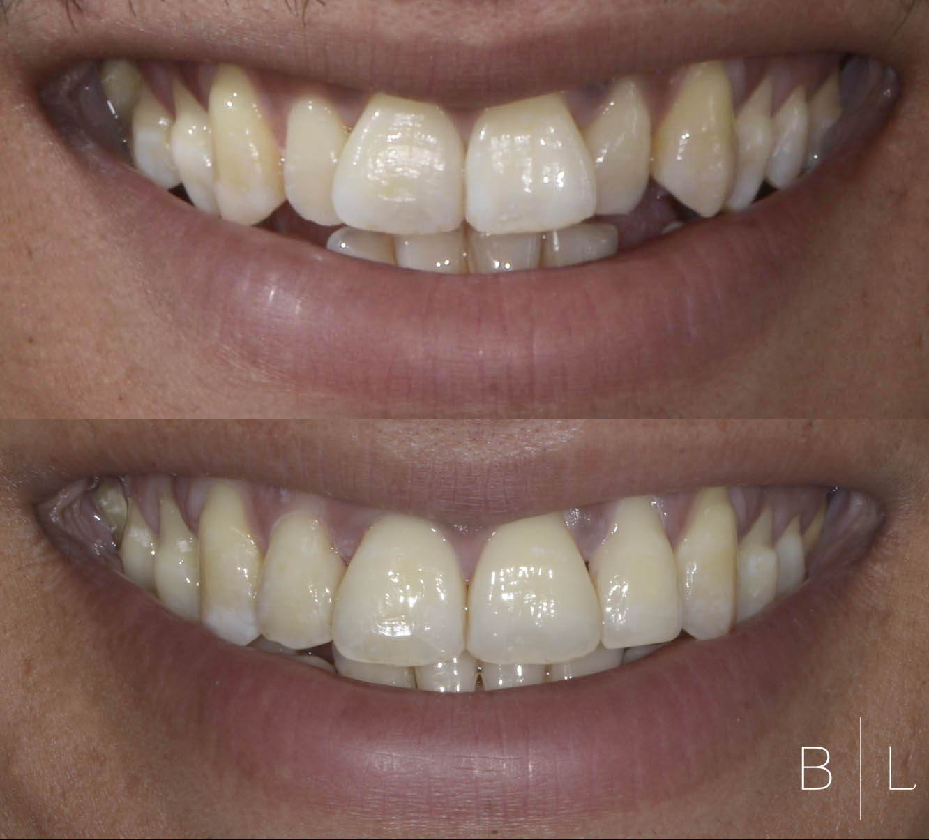 invisalign-antibes-juan-les-pins-c2