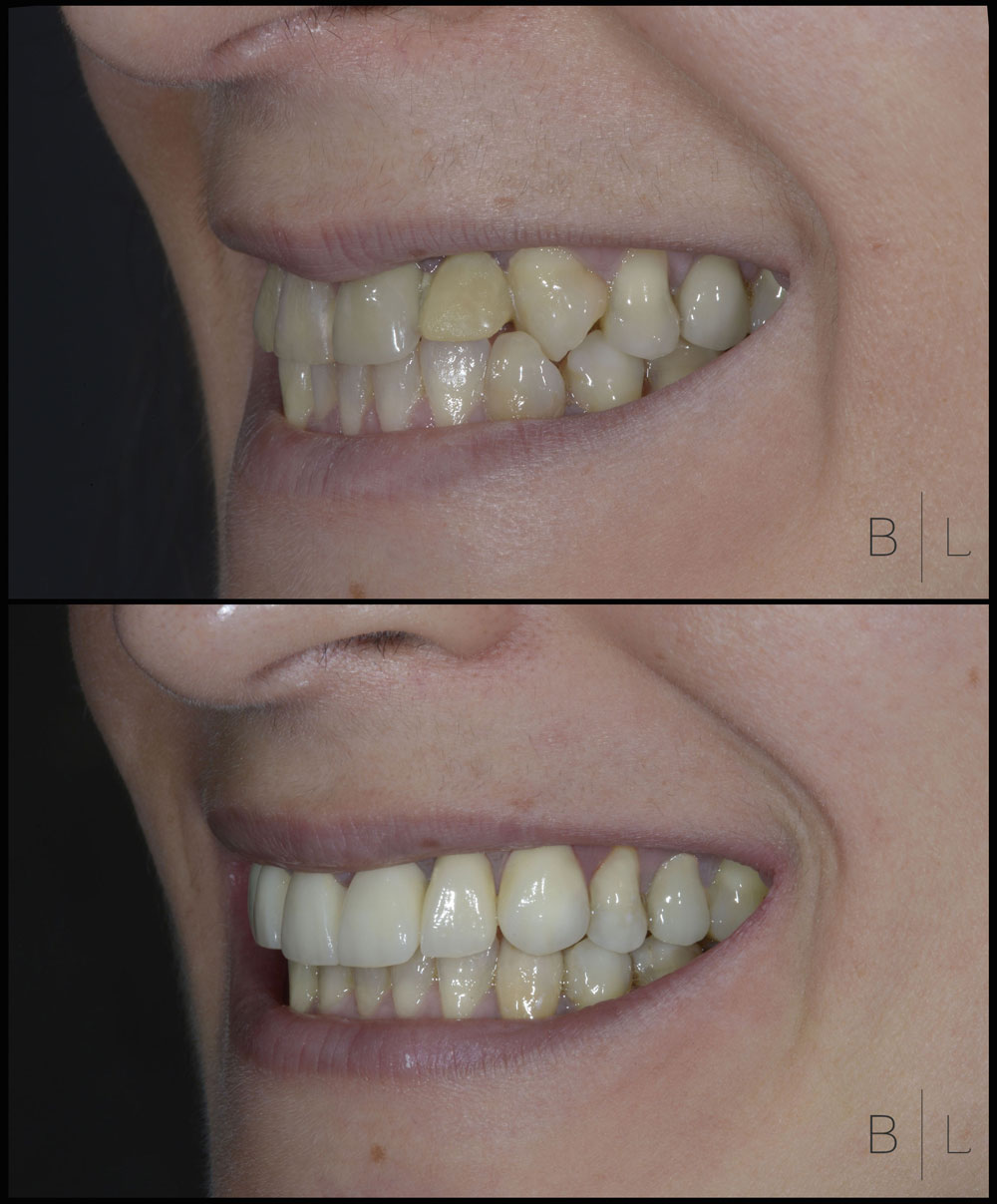 invisalign-antibes-juan-les-pins-c2