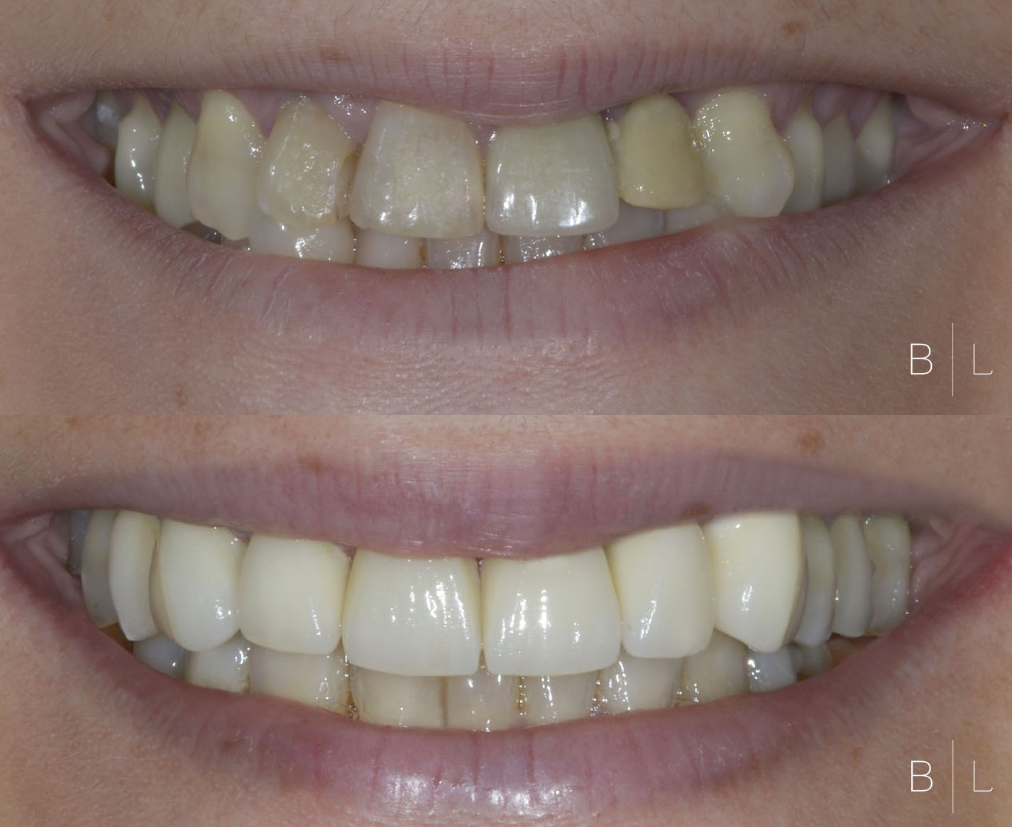 invisalign-antibes-juan-les-pins-c2