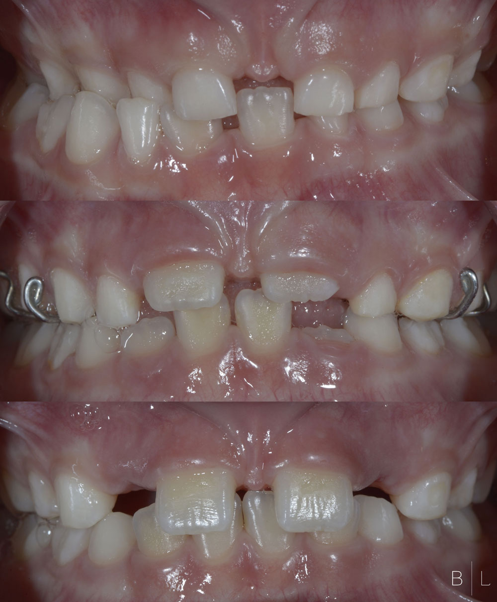 08-orthodontie-enfant-antibes