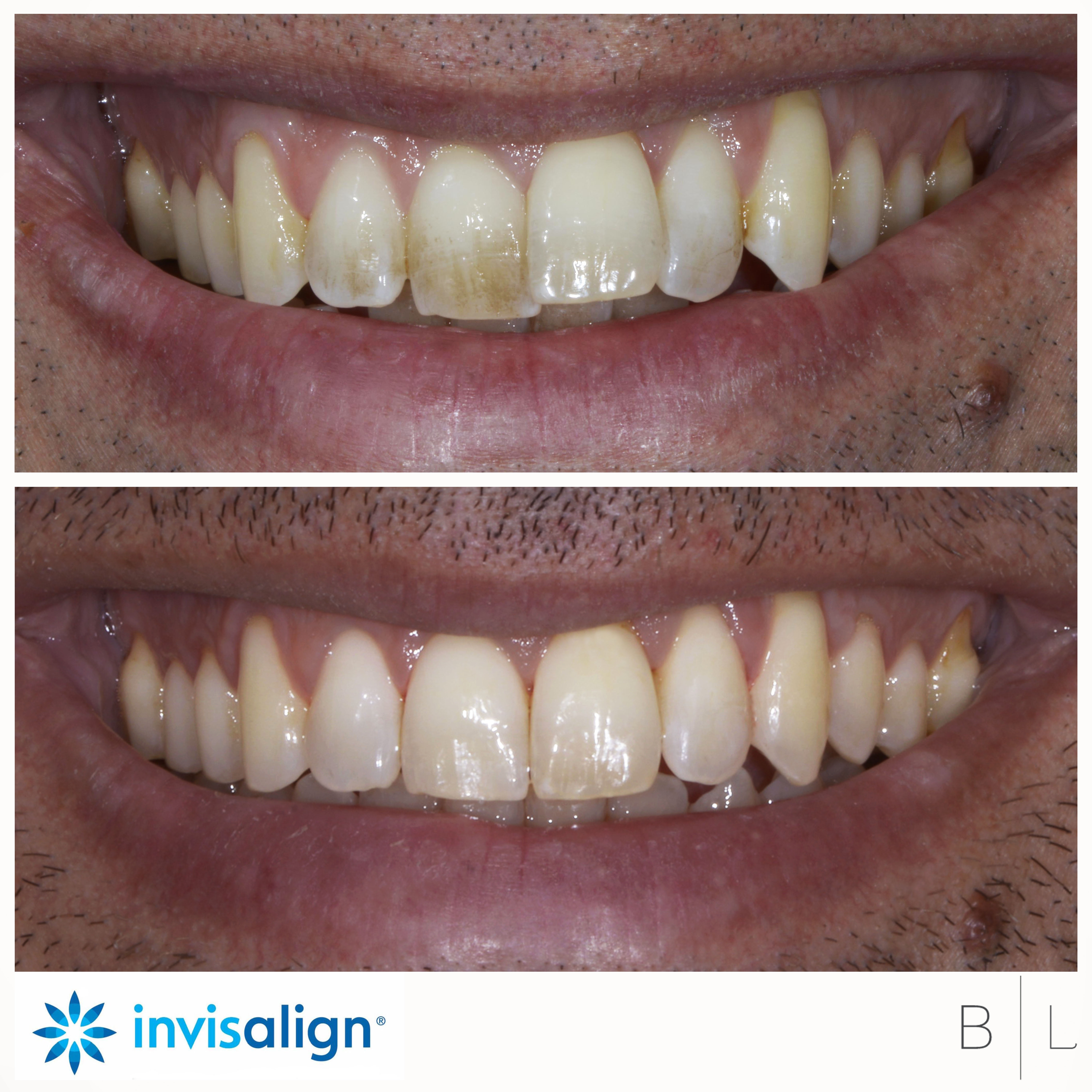 4-invisalign-bensoussan-antibes-dentiste-06