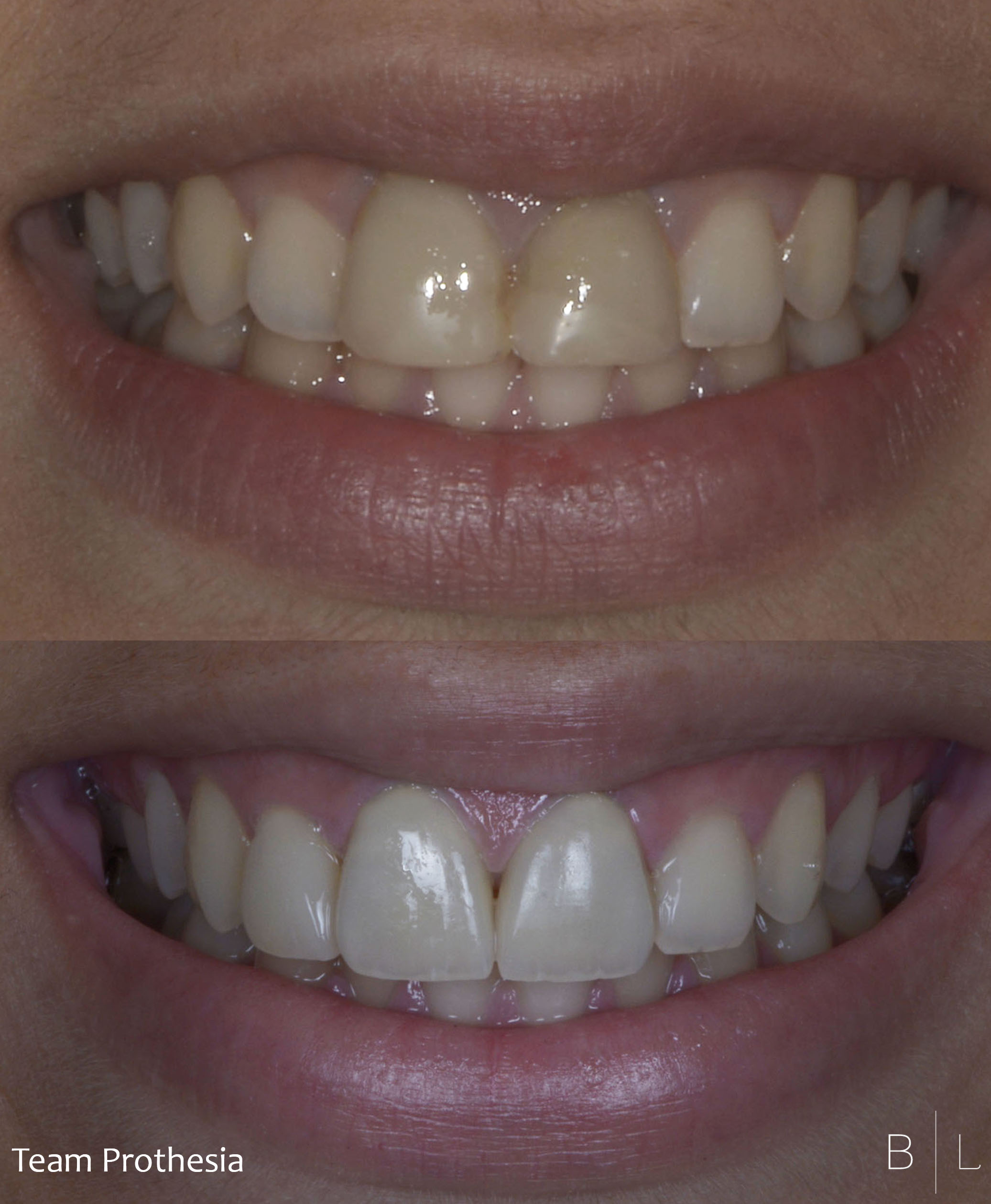 6-dentiste-antibes-blanchiement-facettes