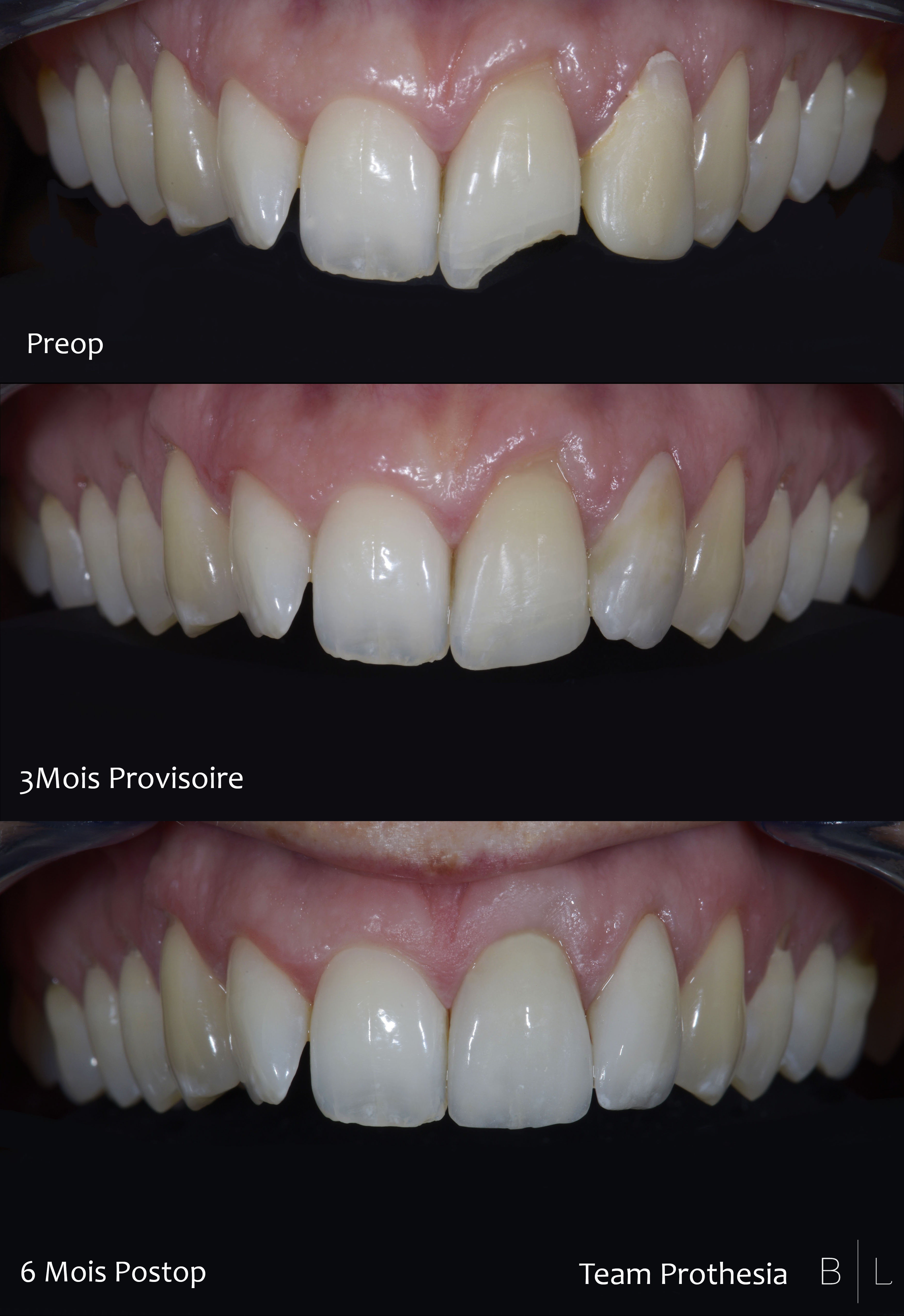 9-facettes-couronne-dentistes-antibes-06-bensoussan