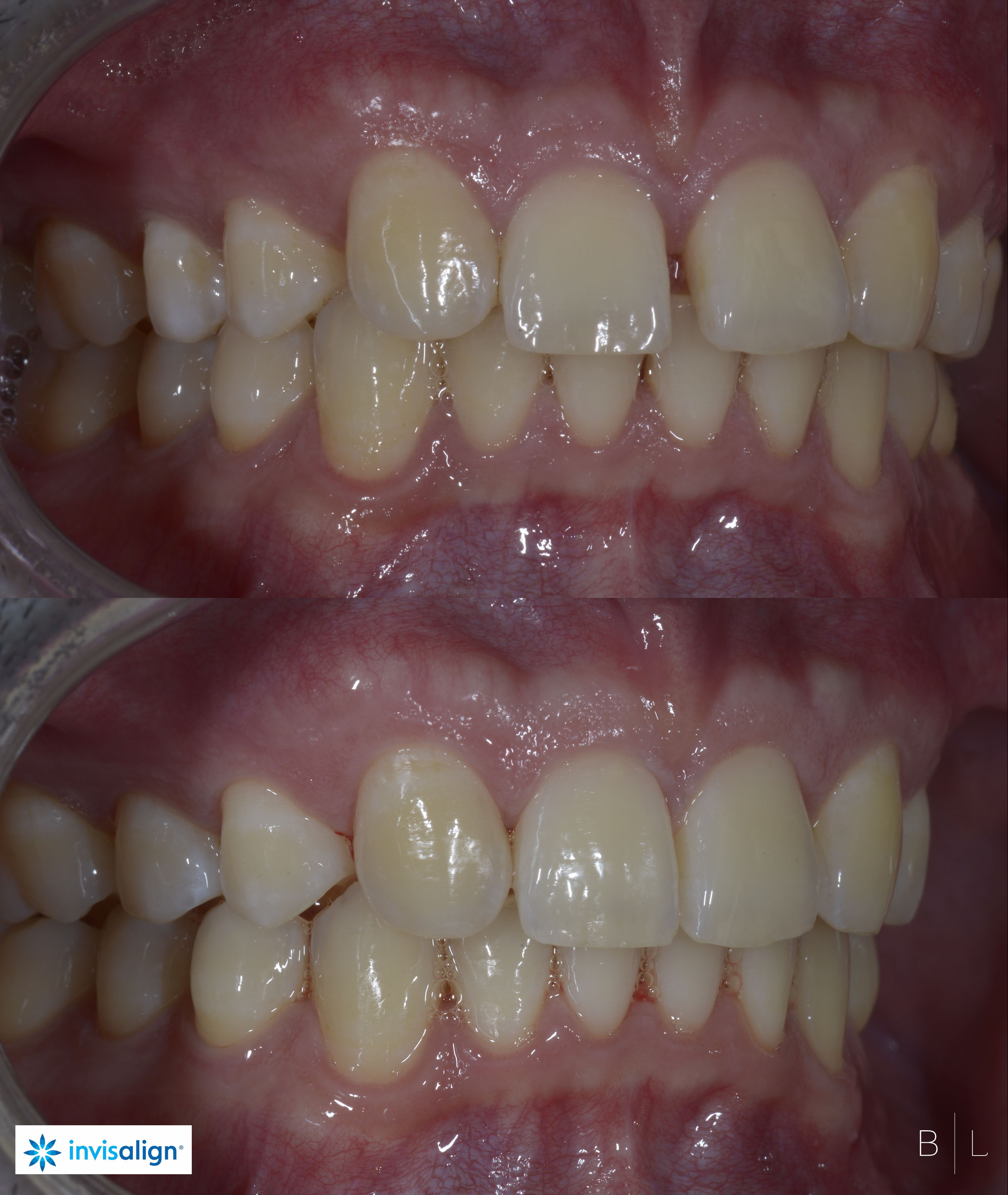 INVISALIGN-dentiste-antibes-2