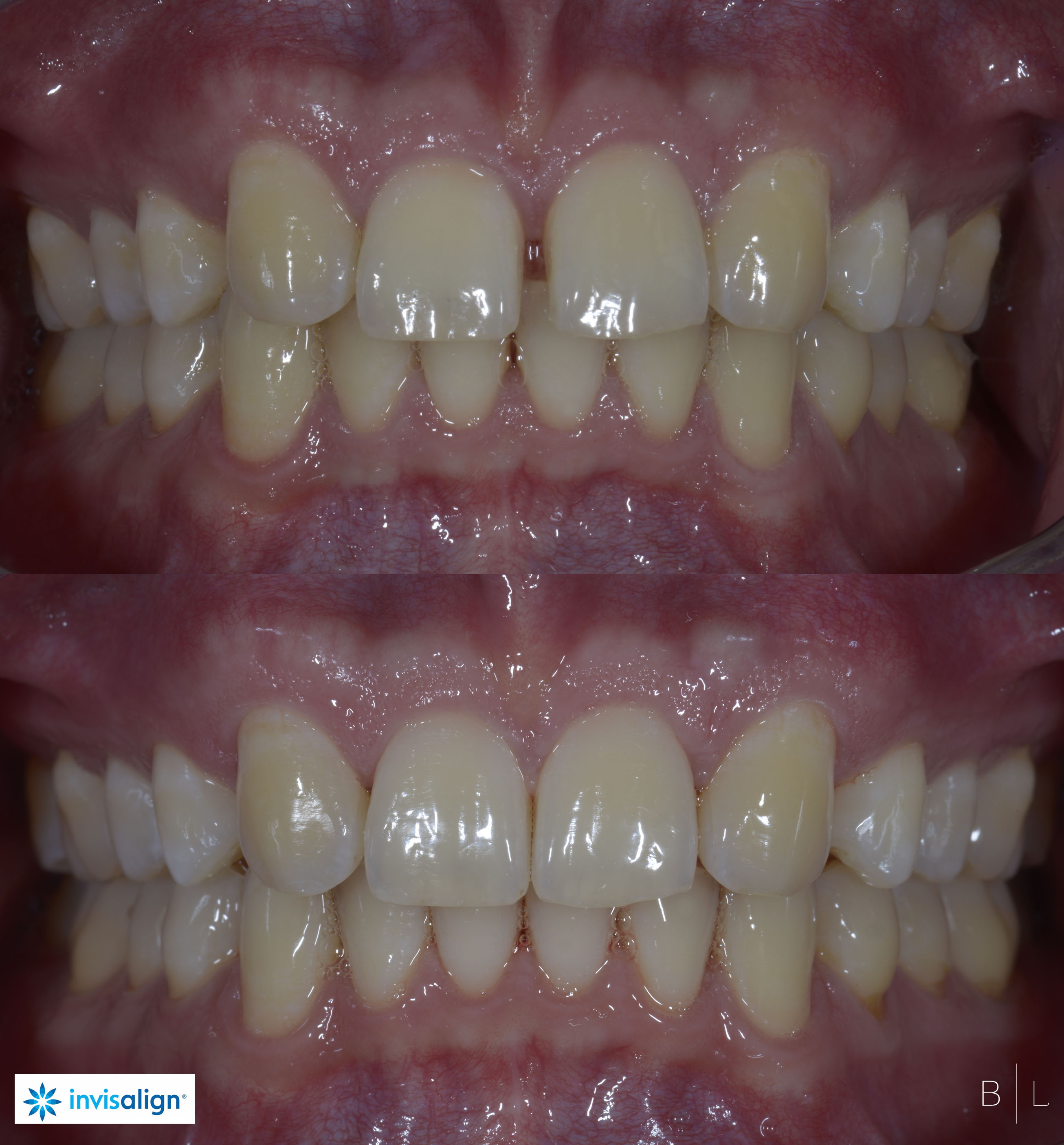 INVISALIGN-dentiste-antibes.jpg-3