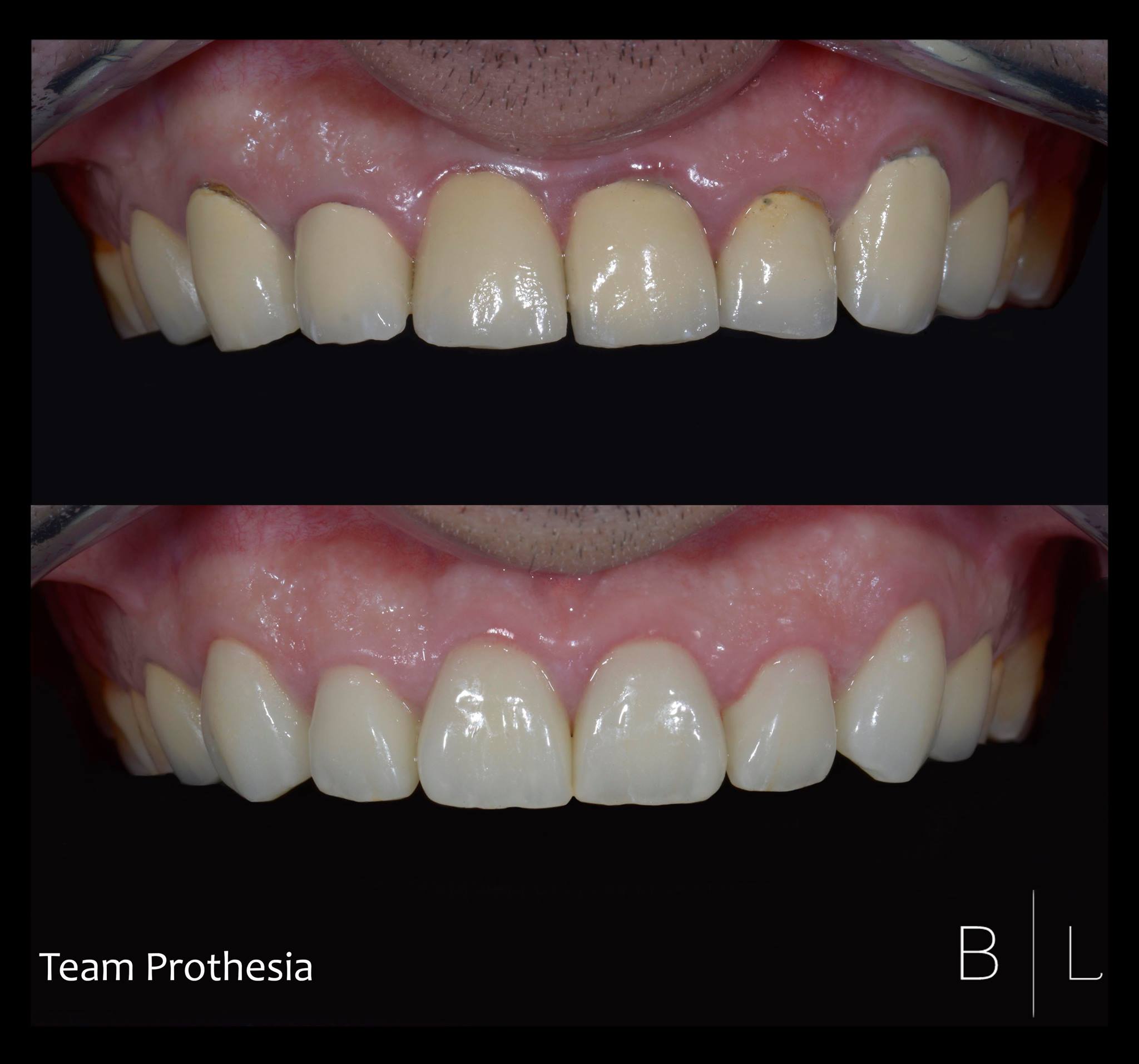 crown-dentist-antibes-invisalign