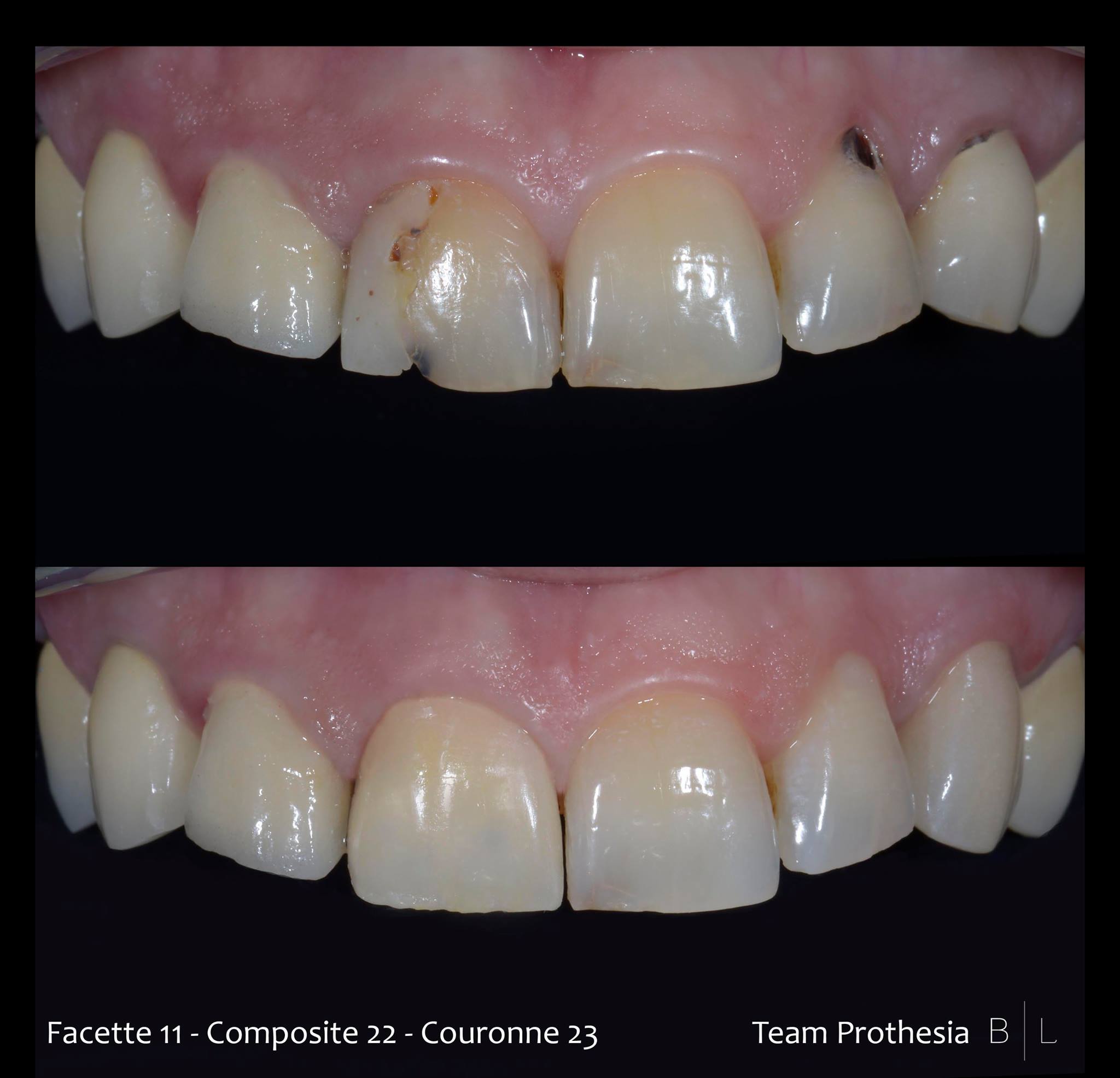 facettes-couronnes-antibes-dentiste