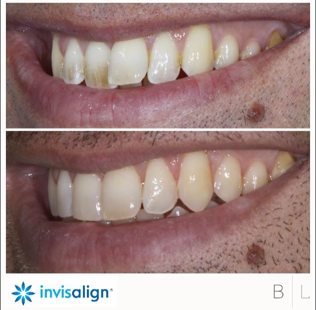 invisalign-antibes-06600