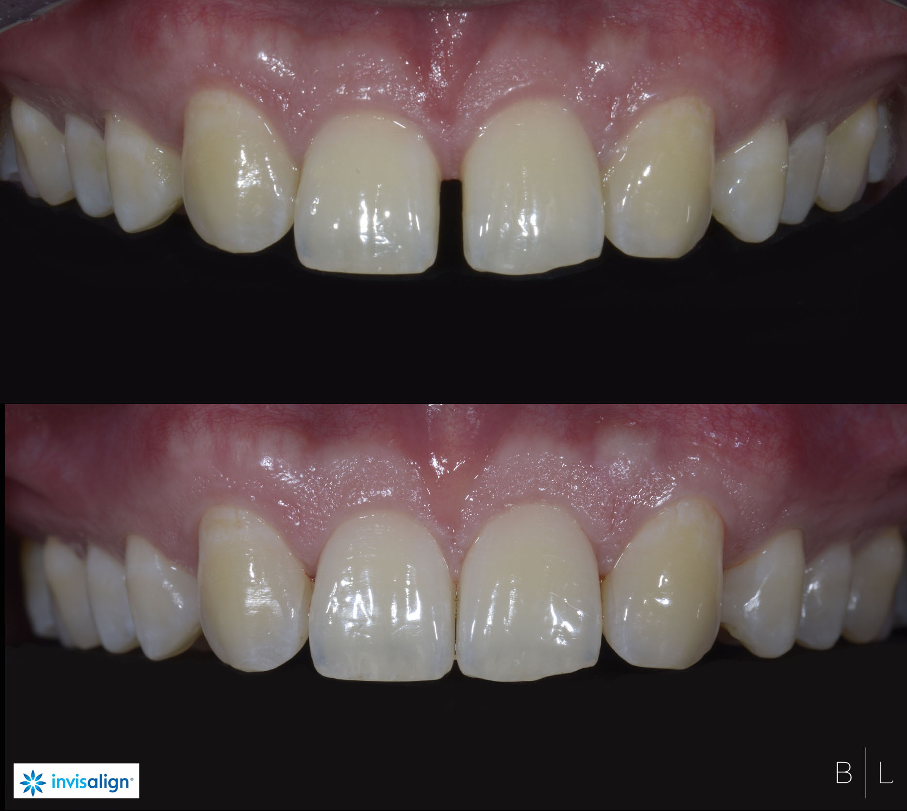 invisalign-antibes-3