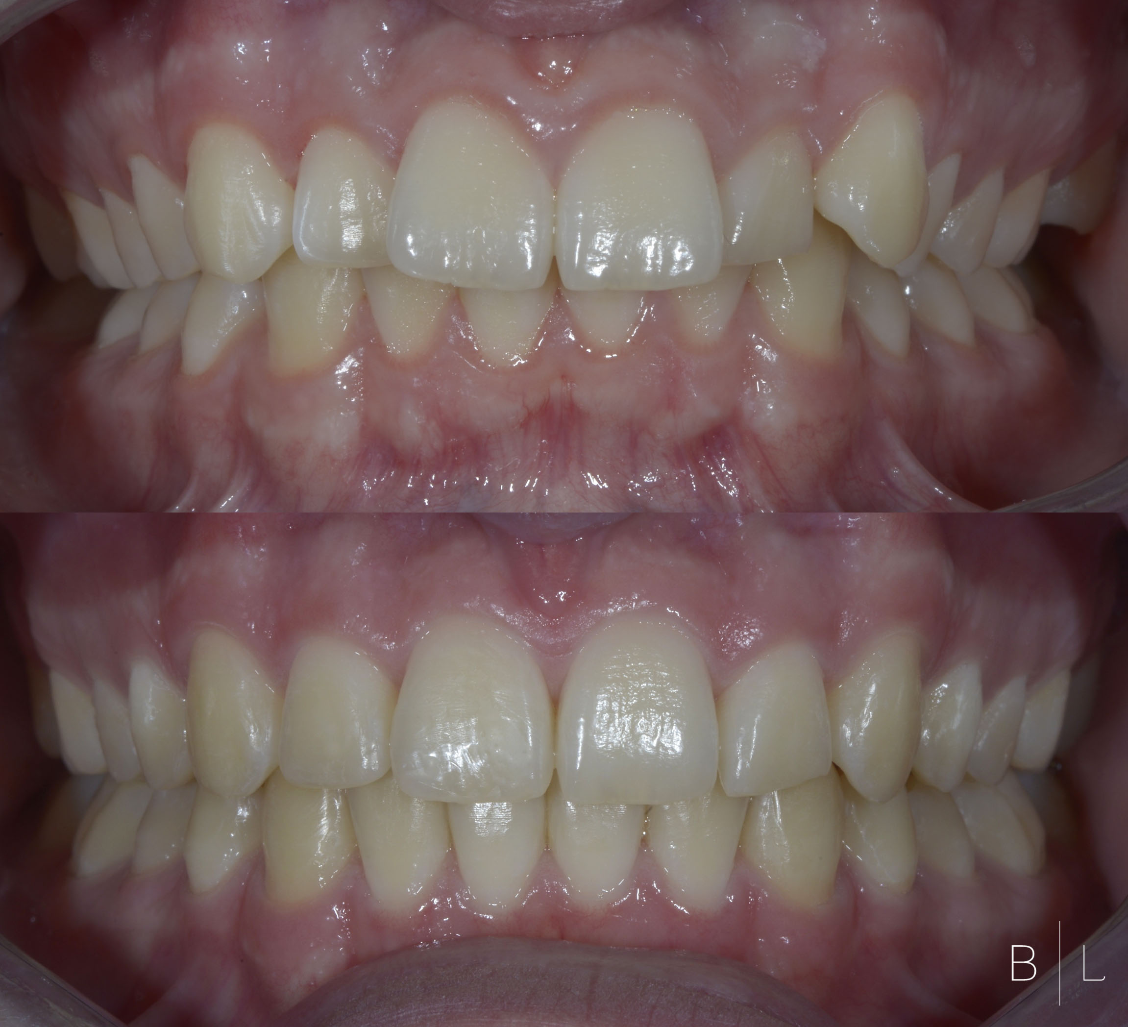 invisalign-antibes-4