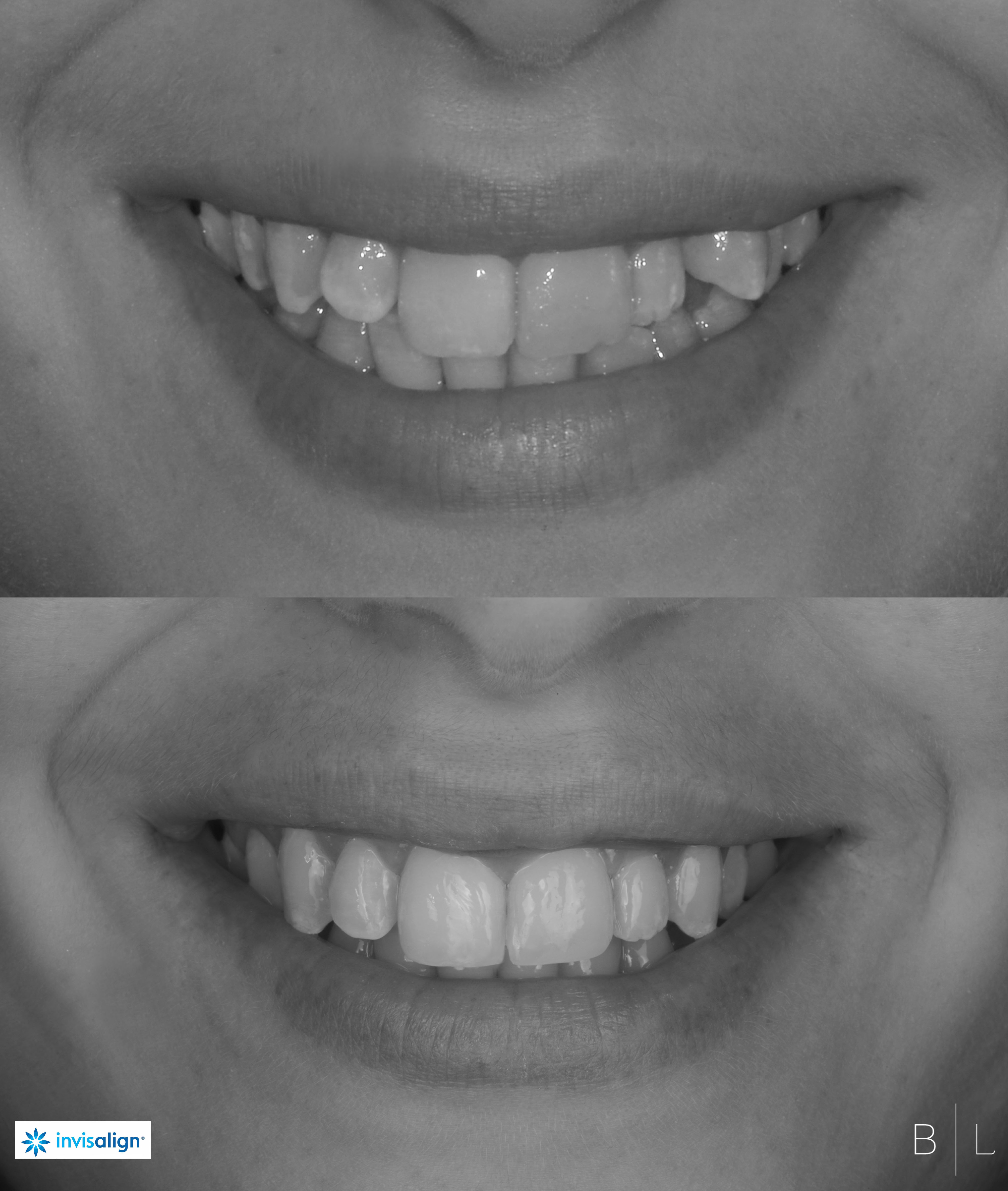 invisalign-antibes-c2