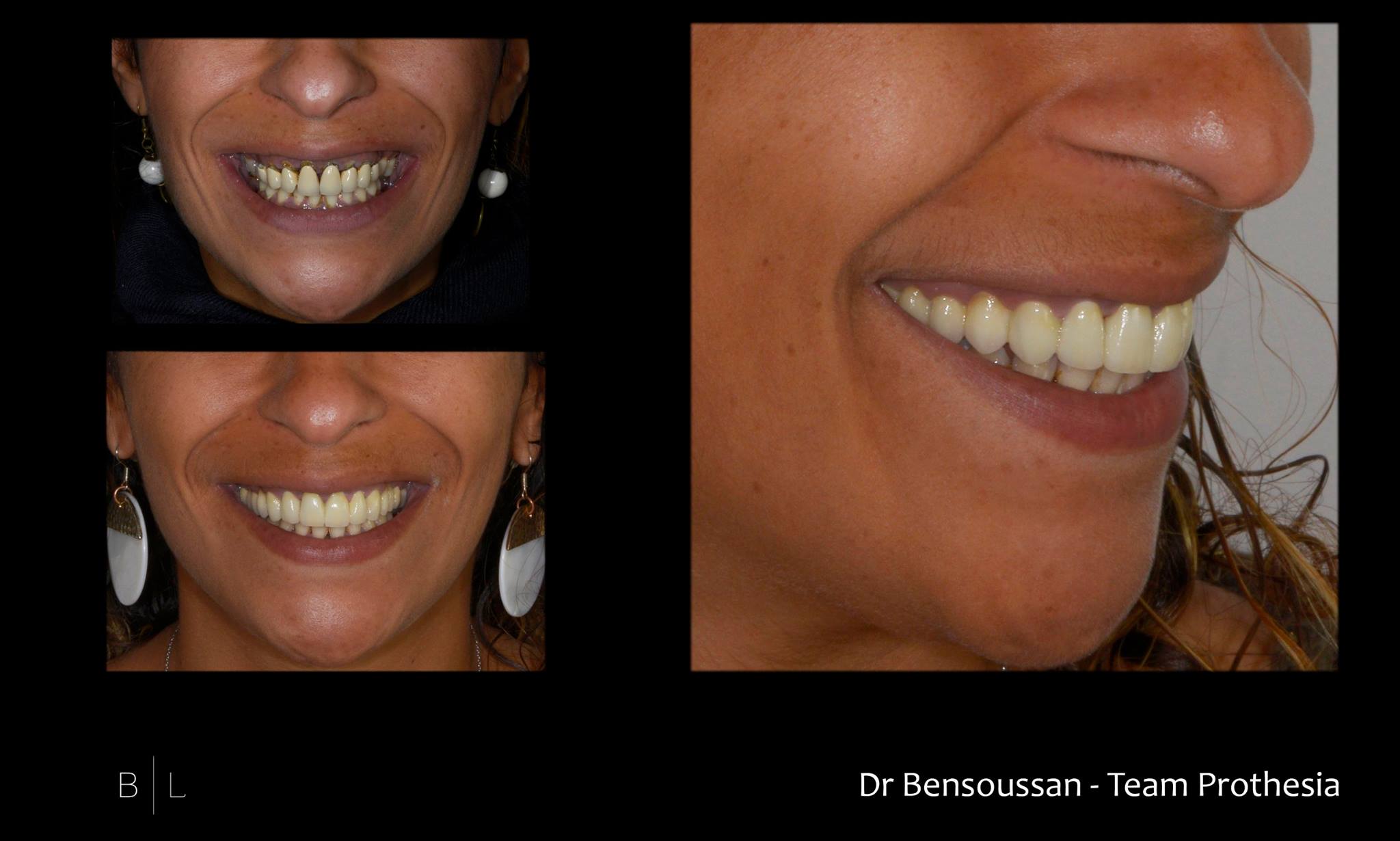 invisalign-antibes-facettes-veneers