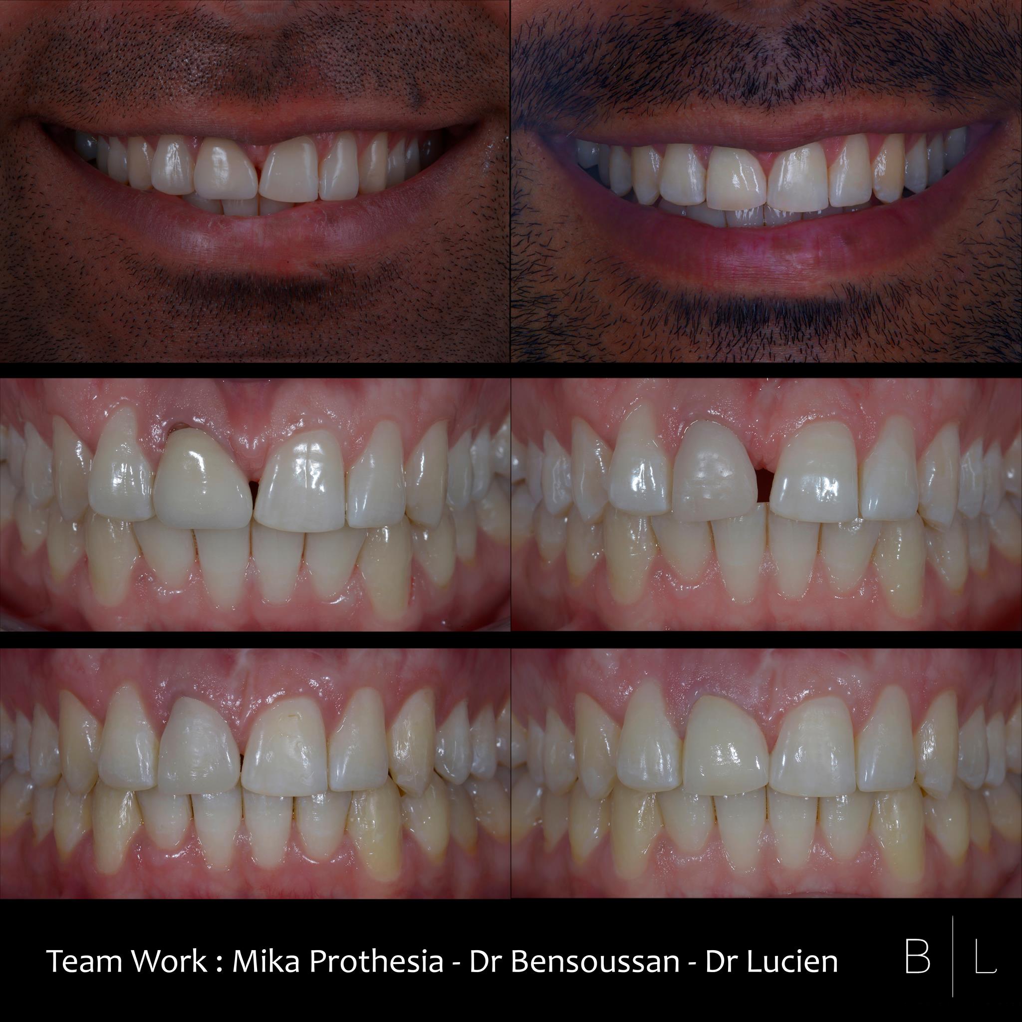 invisalign-antibes-prothese