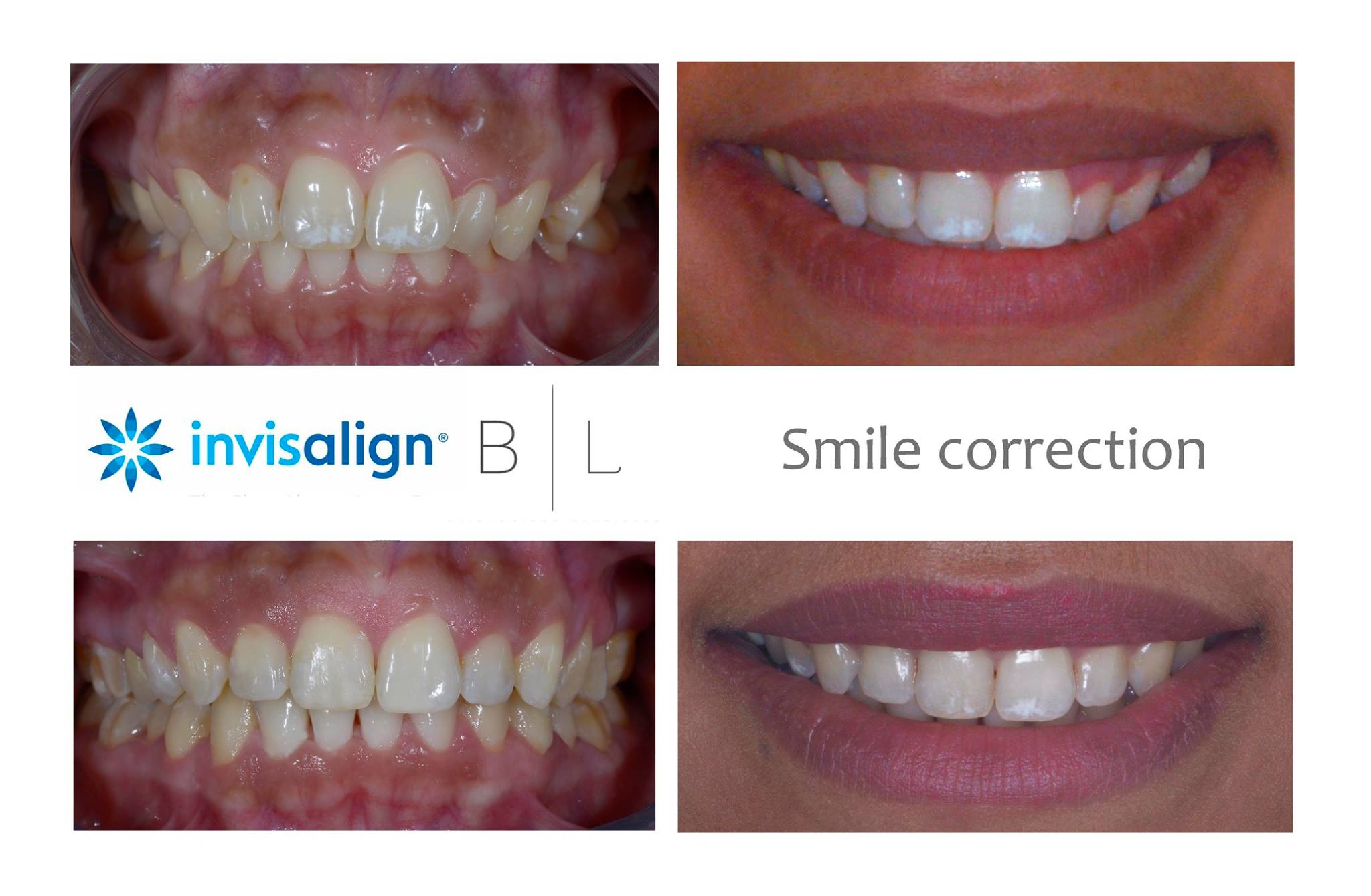 invisalign-dentiste-antibes-06