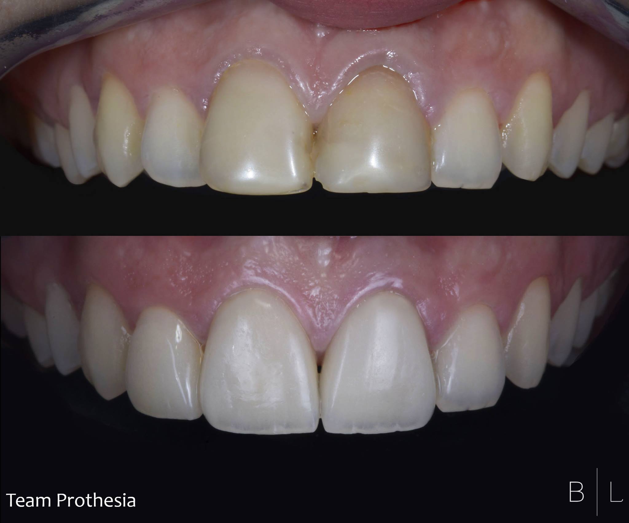 invisalign-france-06000-antibes-veneers