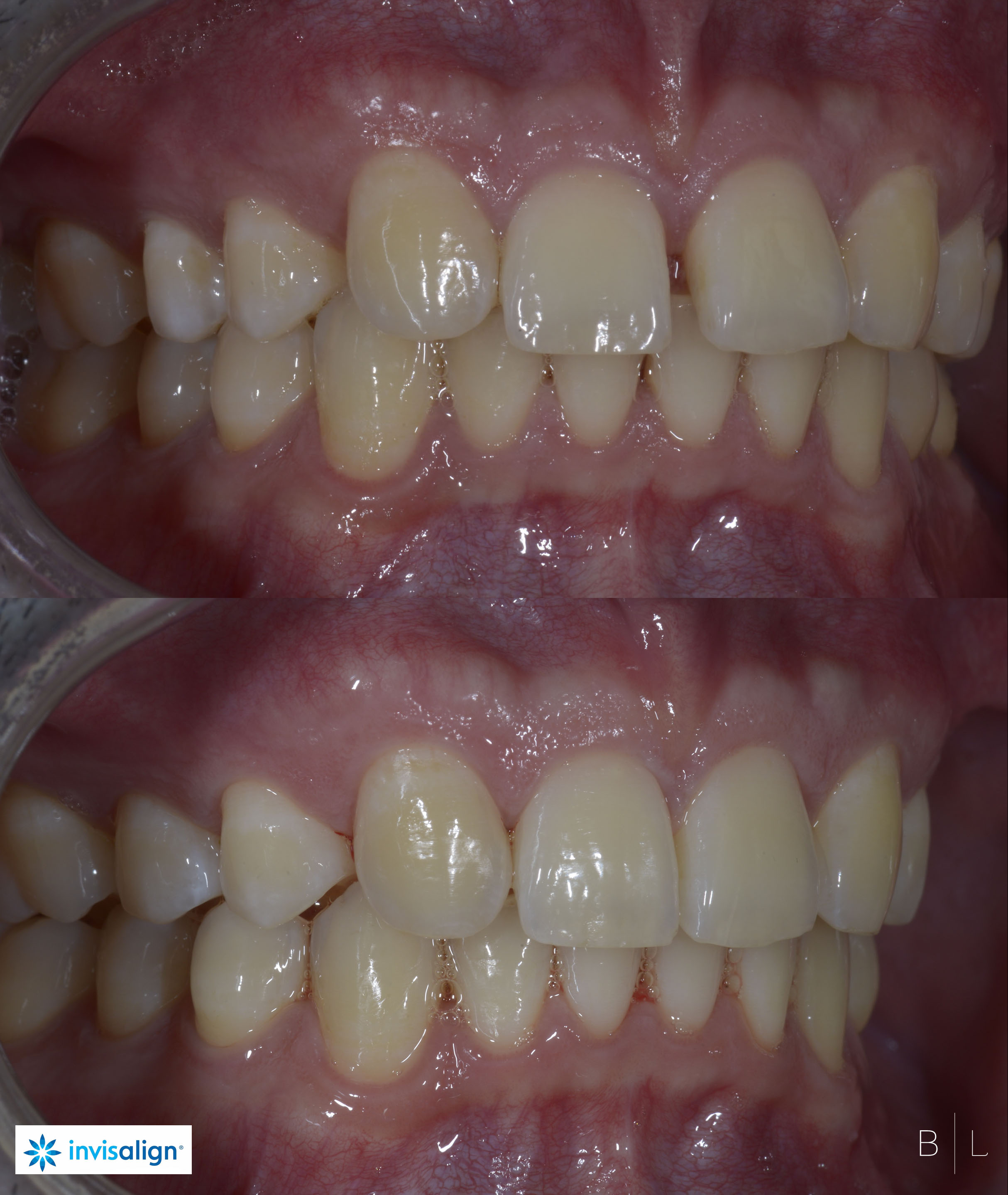 invisalign-juan-les-pins-3