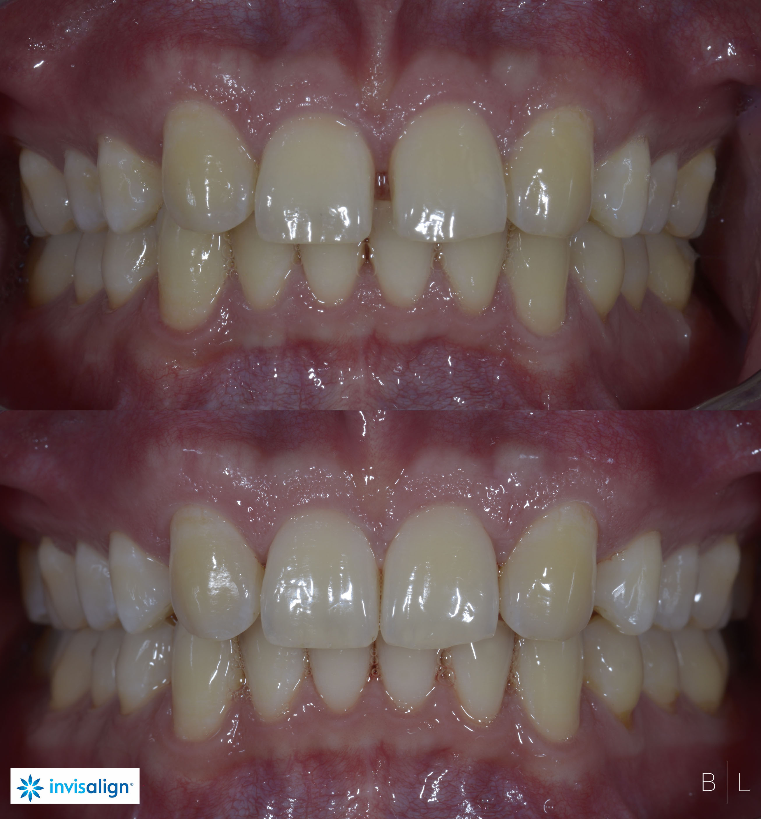 invisalign-sophia-antipolis-3