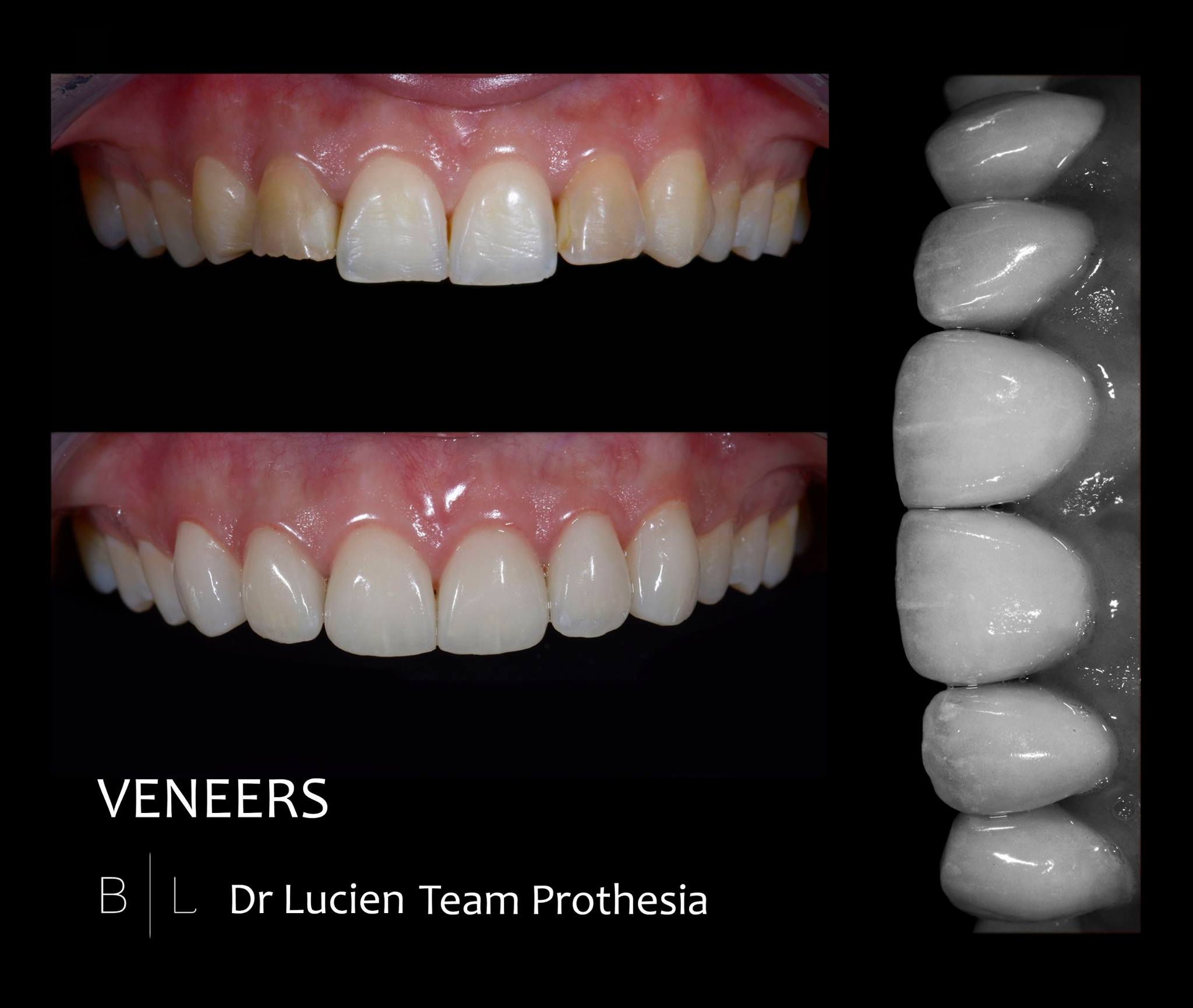 invisalign-veneers-antibes