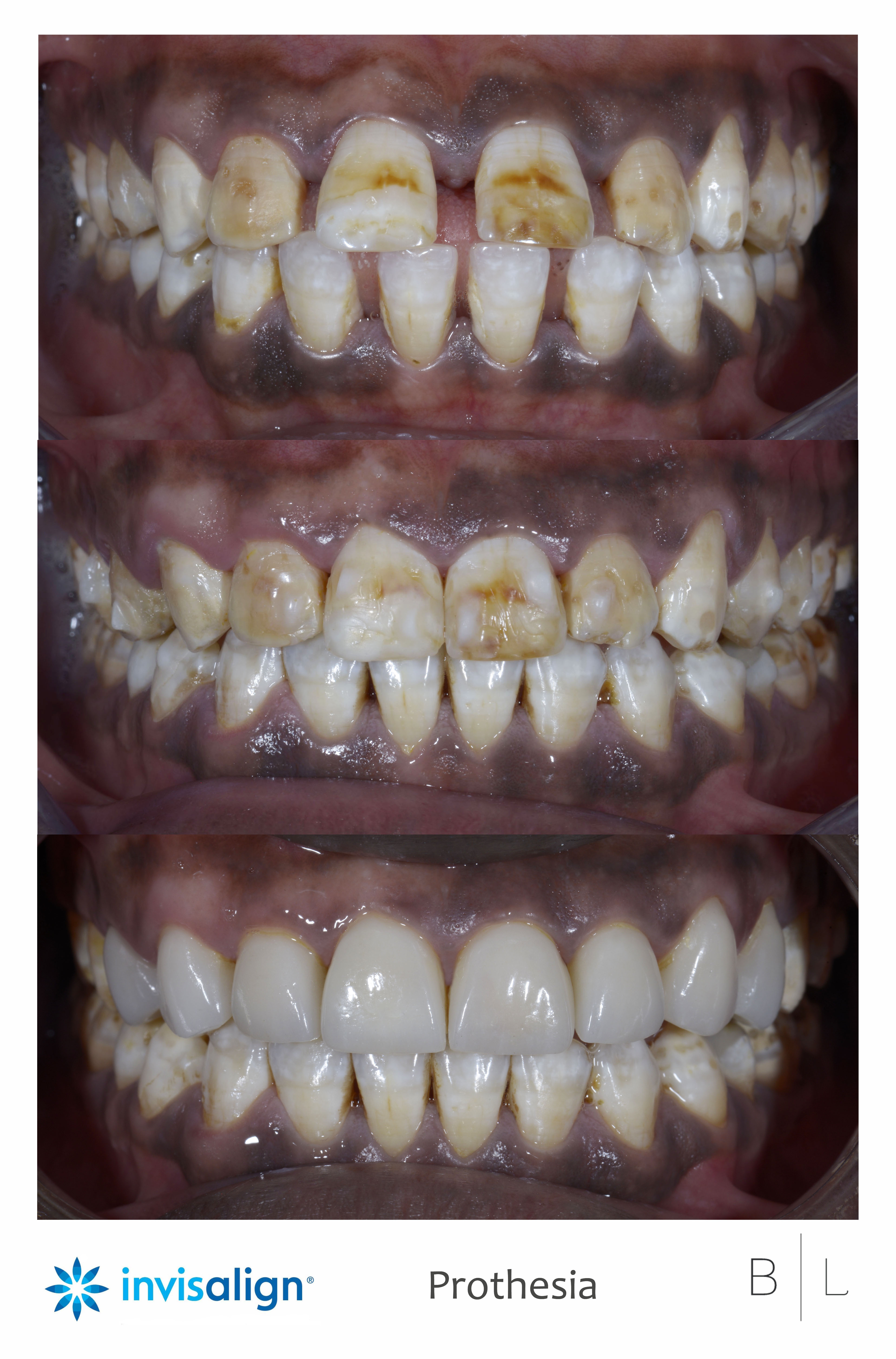 orthodontie-invisalign-facettes-antibes-dentiste-06