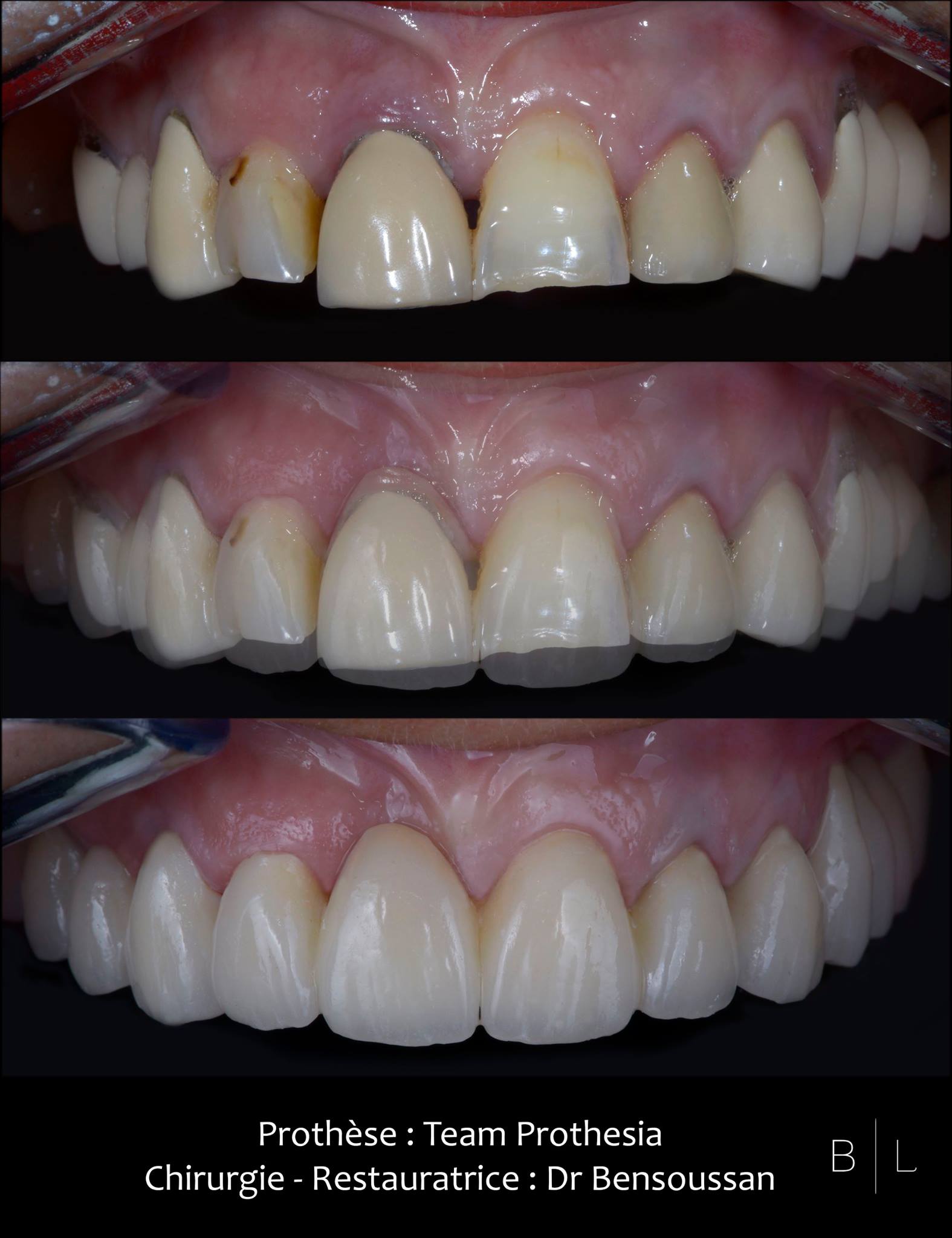 restauration-dents-dentiste-antibes