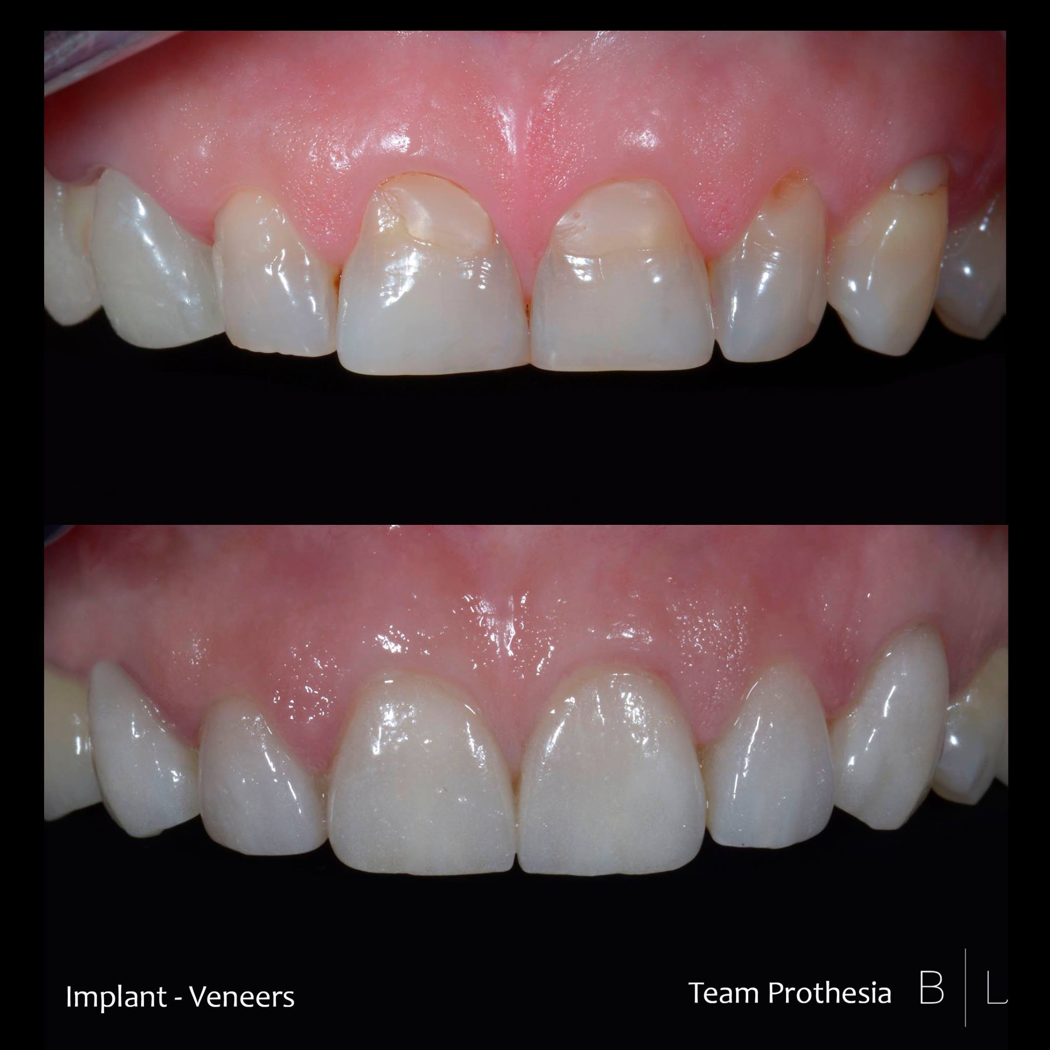 veneers-implant-antibes-dentiste